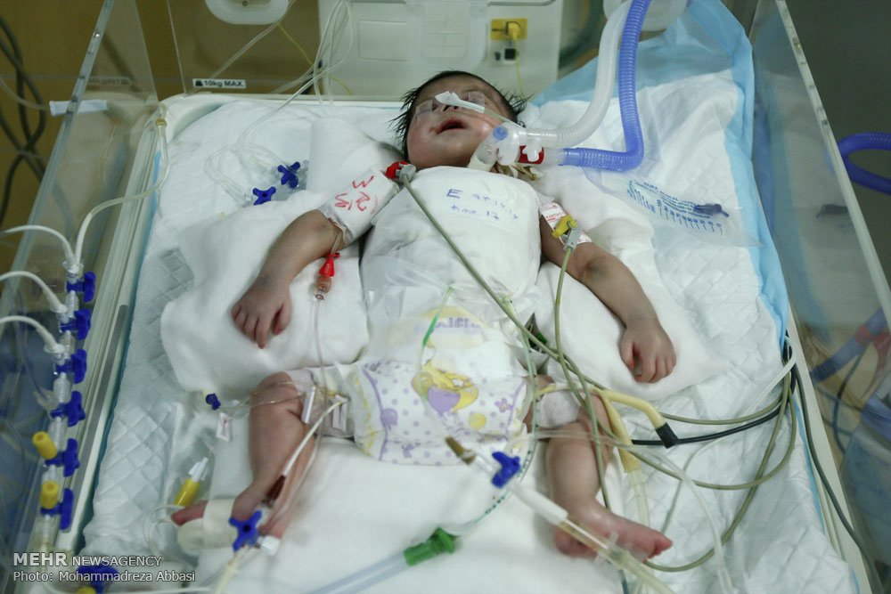 تولد نوزاد قمی با توده ۳۰ کیلوگرمی – پایگاه خبری شهرکریمه | اخبار ایران و جهان